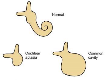 common cavity1.jpg