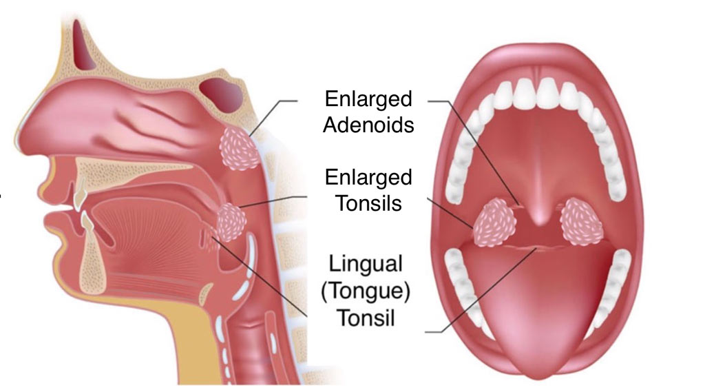 Enlarged-Tonsils-and-Adenoids.jpg