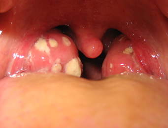 Tonsillitis.jpg