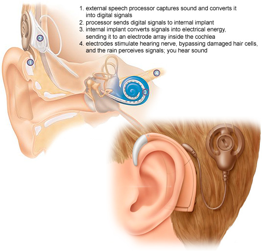 Cochlear-implant.jpg